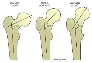 Variation-in-femur-angles