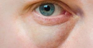 How-to-Get-Rid-of-Dark-Circles-Under-Eyes-800x416