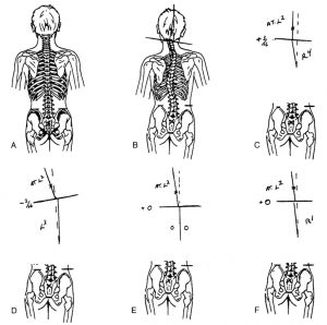 Atlas-and-spinal-alignement-2