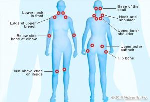detail_fibromyalgia