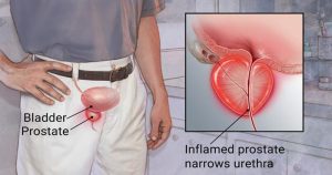 Prostatitis-Symptoms-Cause-and-Treatment
