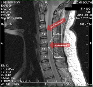 c3-c4-herniation-and-c5-c6-herniation1